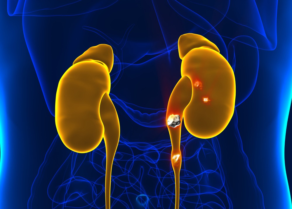 Litiasis Renal