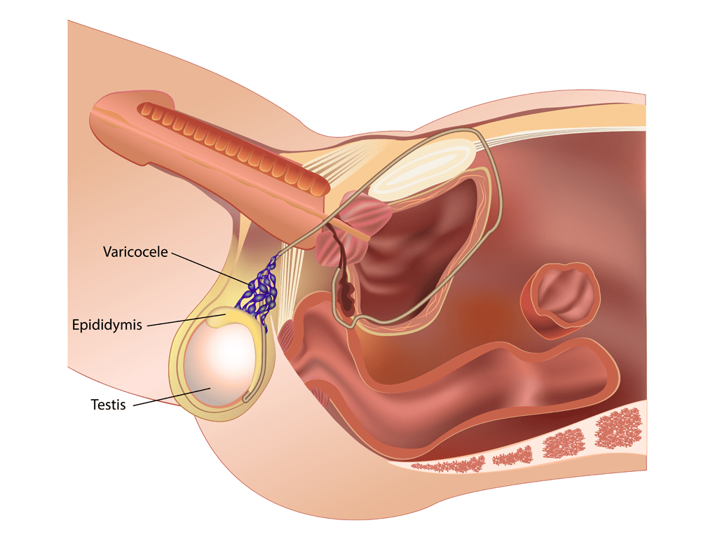 Varicocele